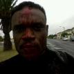 Albert Kafuka was assaulted by his land lady and family. Photo courtesy of Albert Kafuka. Albert Kafuka was assaulted by his land lady and family. Photo courtesy of Albert Kafuka.