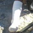 Cynthia's cemented leg after Sizwe broke it. Photo by Cynthia. Cynthia's cemented leg after Sizwe broke it. Photo by Cynthia.