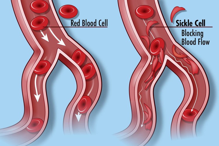 Summary image for article