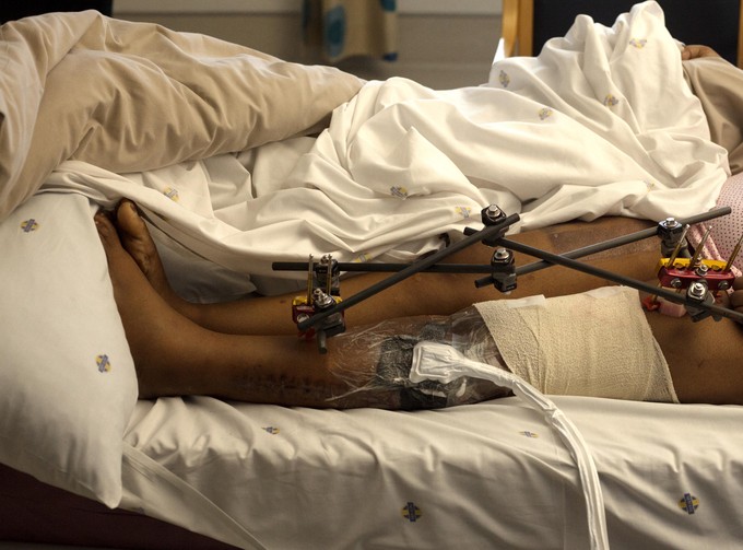 Photo of person with injured leg in hospital bed.