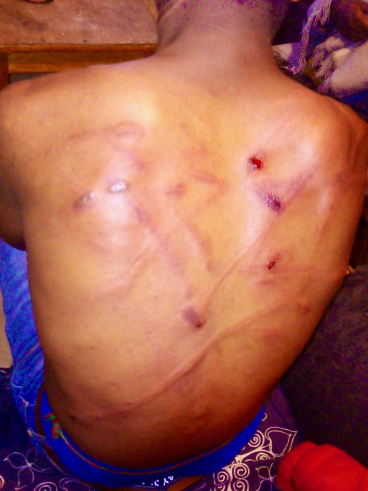 Photo of a man\'s scarred and bleeding back