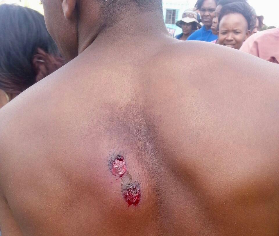 Photo of a person's back with rubber bullet wounds